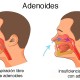 Vegetaciones o adenoides