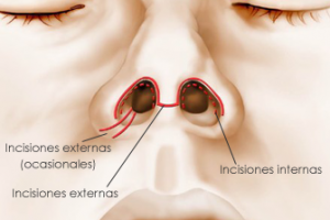 cirugia-nariz-incisiones